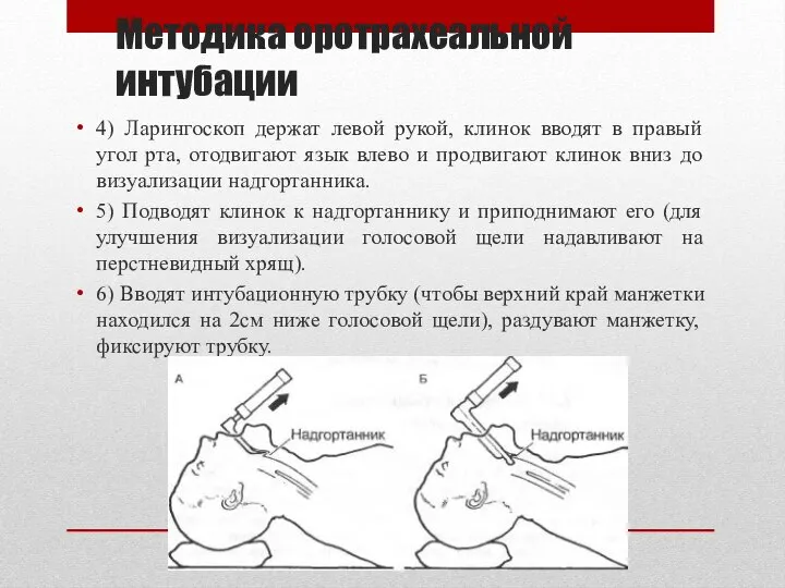 Методика оротрахеальной интубации 4) Ларингоскоп держат левой рукой, клинок вводят в правый