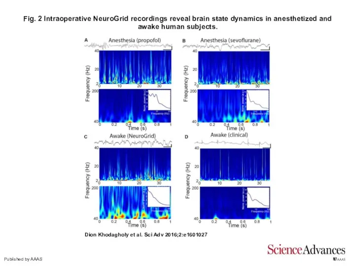 Fig. 2 Intraoperative NeuroGrid recordings reveal brain state dynamics in anesthetized and