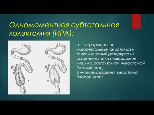 Одномоментная субтотальная колэктомия (ИРА): а — сформирован илеоректальный анастомоз и тонкокишечный резервуар