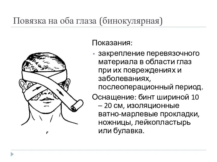 Повязка на оба глаза (бинокулярная) Показания: закрепление перевязочного материала в области глаз