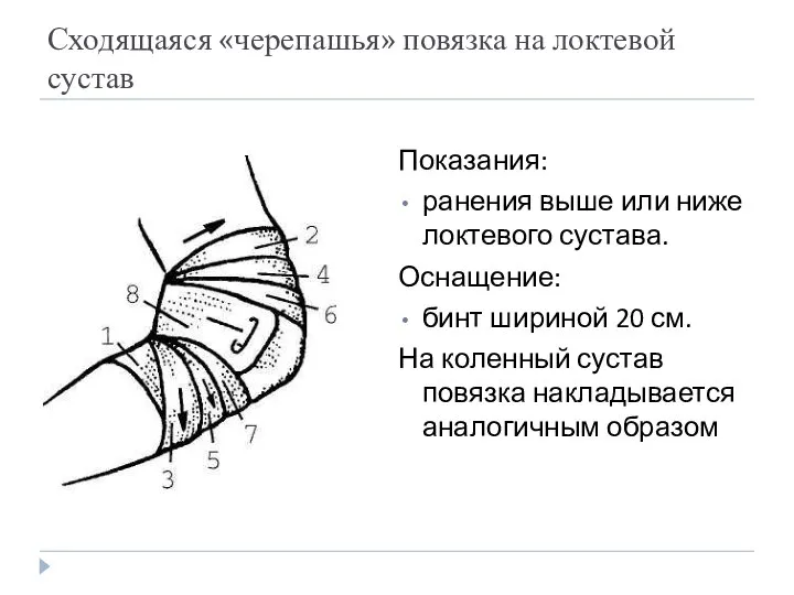 Сходящаяся «черепашья» повязка на локтевой сустав Показания: ранения выше или ниже локтевого