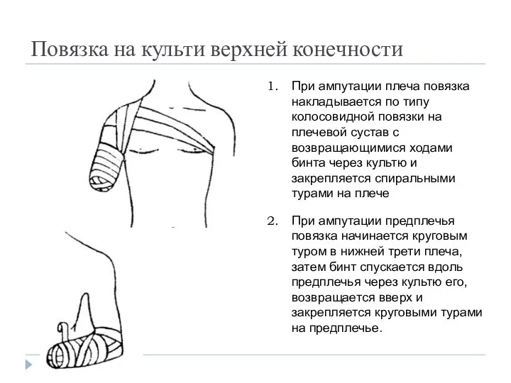 Повязка на культи верхней конечности При ампутации плеча повязка накладывается по типу