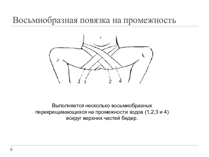 Восьмиобразная повязка на промежность Выполняется несколько восьмиобразных перекрещивающихся на промежности ходов (1,2,3