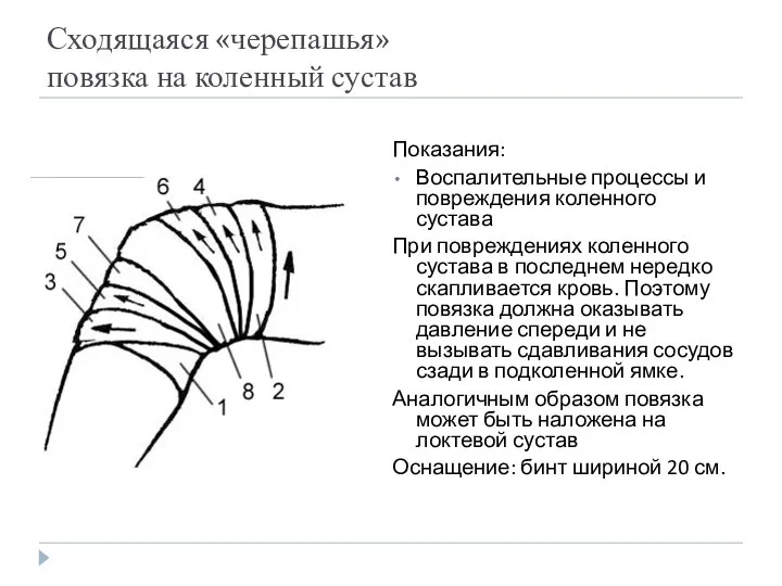 Сходящаяся «черепашья» повязка на коленный сустав Показания: Воспалительные процессы и повреждения коленного