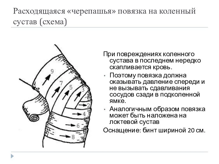 Расходящаяся «черепашья» повязка на коленный сустав (схема) При повреждениях коленного сустава в