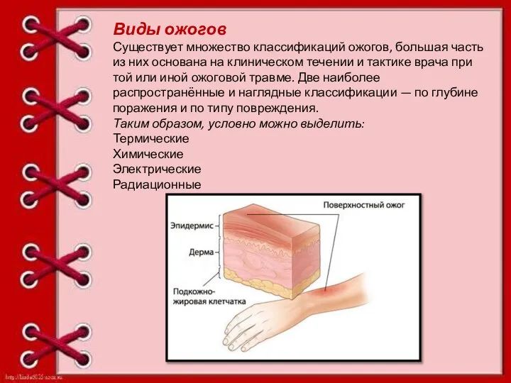Виды ожогов Существует множество классификаций ожогов, большая часть из них основана на