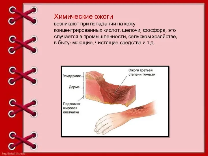 Химические ожоги возникают при попадании на кожу концентрированных кислот, щелочи, фосфора, это