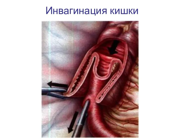 Инвагинация кишки