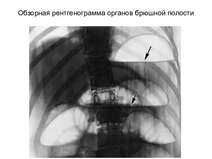 Обзорная рентгенограмма органов брюшной полости