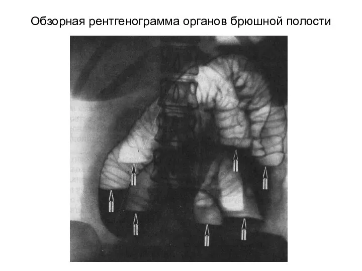 Обзорная рентгенограмма органов брюшной полости
