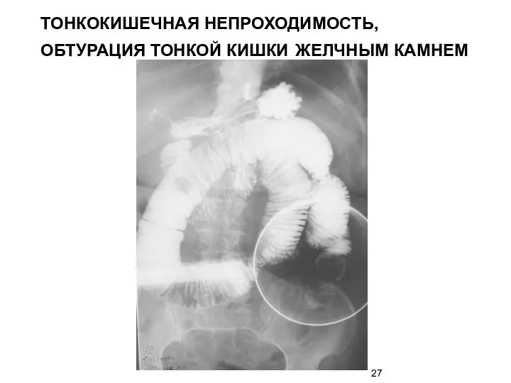 ТОНКОКИШЕЧНАЯ НЕПРОХОДИМОСТЬ, ОБТУРАЦИЯ ТОНКОЙ КИШКИ ЖЕЛЧНЫМ КАМНЕМ