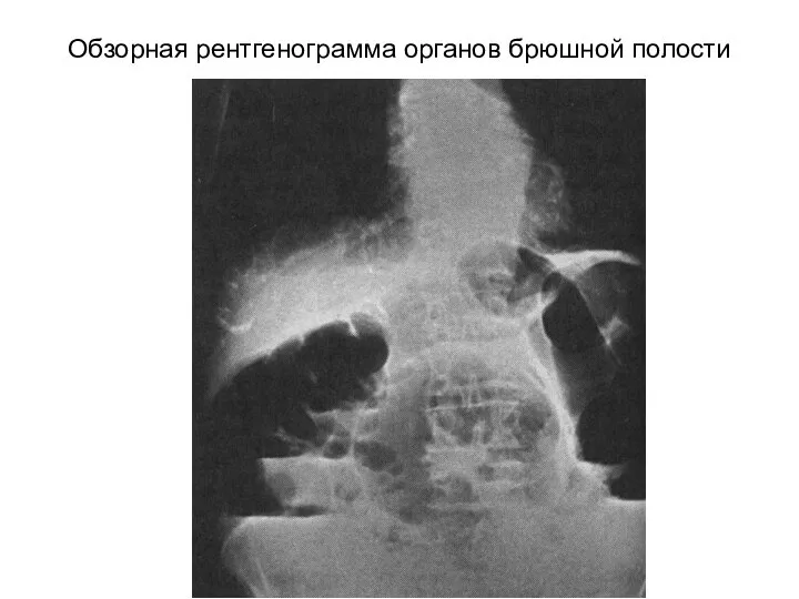 Обзорная рентгенограмма органов брюшной полости