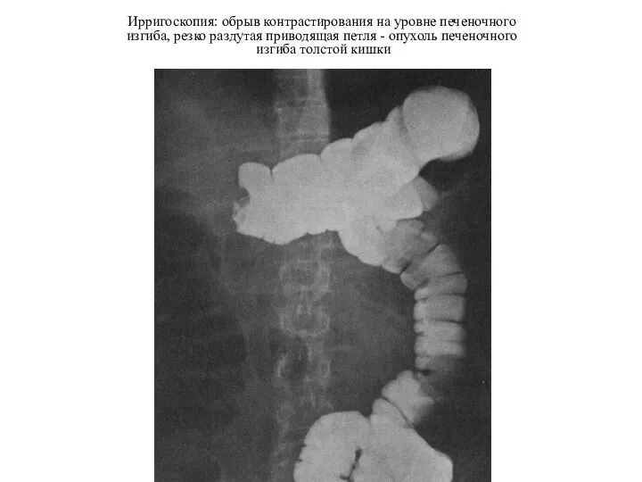 Ирригоскопия: обрыв контрастирования на уровне печеночного изгиба, резко раздутая приводящая петля -