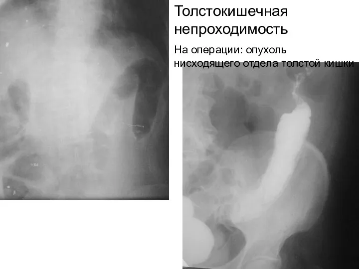 Толстокишечная непроходимость На операции: опухоль нисходящего отдела толстой кишки