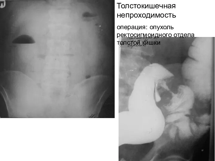 Толстокишечная непроходимость операция: опухоль ректосигмоидного отдела толстой кишки