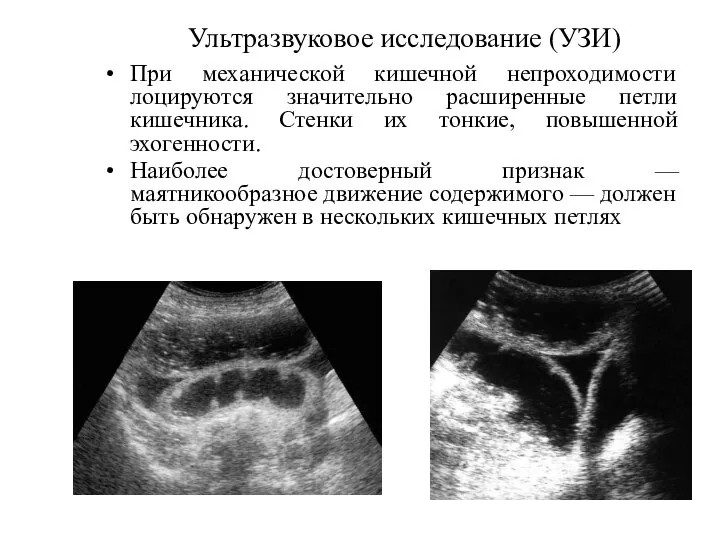 Ультразвуковое исследование (УЗИ) При механической кишечной непроходимости лоцируются значительно расширенные петли кишечника.