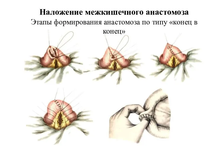 Наложение межкишечного анастомоза Этапы формирования анастомоза по типу «конец в конец»