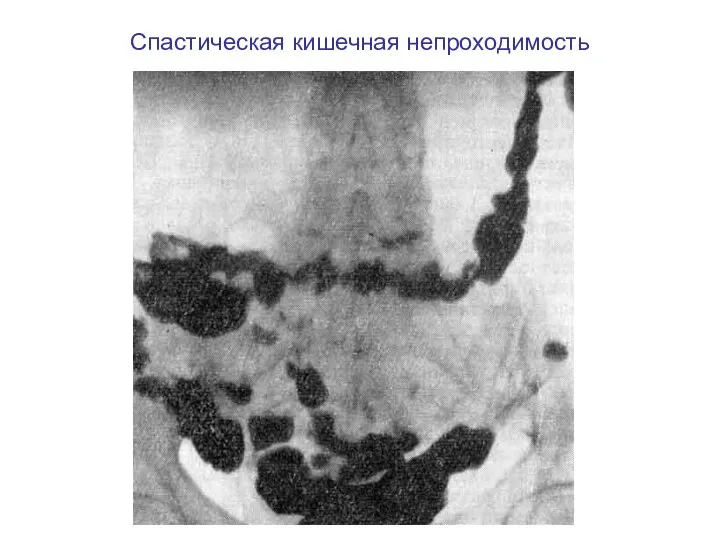 Спастическая кишечная непроходимость