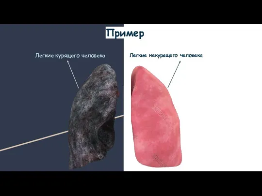 Пример Легкие курящего человека Легкие некурящего человека