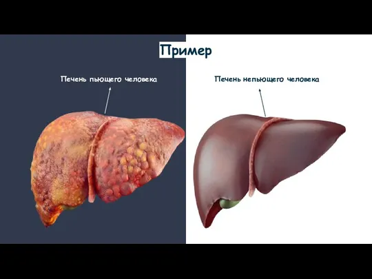 Пример Печень пьющего человека Печень непьющего человека