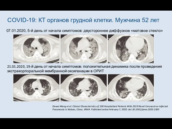 COVID-19: КТ органов грудной клетки. Мужчина 52 лет 07.01.2020, 5-й день от