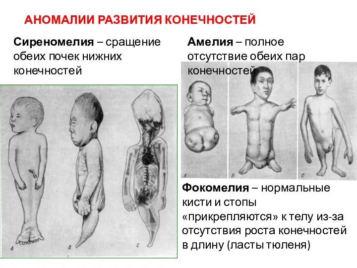 АНОМАЛИИ РАЗВИТИЯ КОНЕЧНОСТЕЙ Сиреномелия – сращение обеих почек нижних конечностей Амелия –