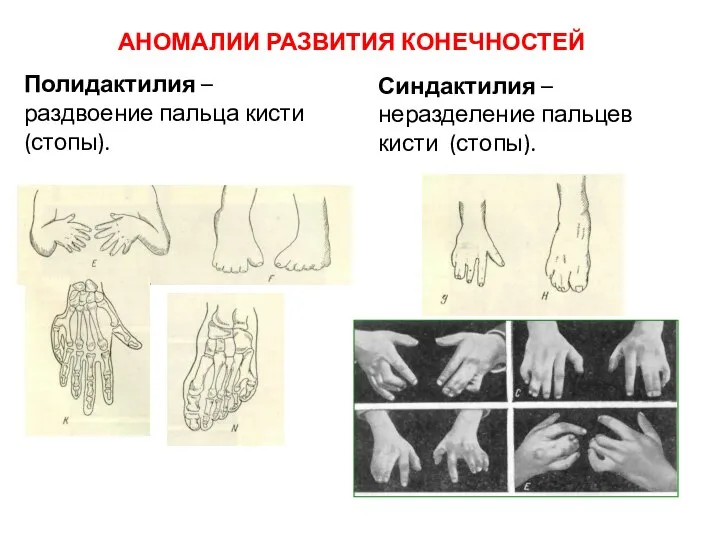 Полидактилия – раздвоение пальца кисти (стопы). Синдактилия – неразделение пальцев кисти (стопы). АНОМАЛИИ РАЗВИТИЯ КОНЕЧНОСТЕЙ