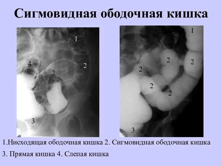 Сигмовидная ободочная кишка 1.Нисходящая ободочная кишка 2. Сигмовидная ободочная кишка 3. Прямая