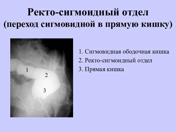 Ректо-сигмоидный отдел (переход сигмовидной в прямую кишку) 1. Сигмовидная ободочная кишка 2.