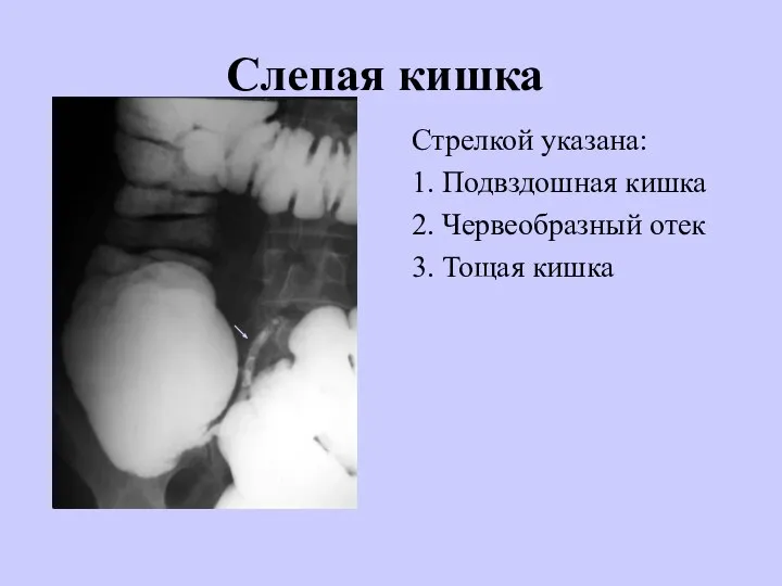 Слепая кишка Стрелкой указана: 1. Подвздошная кишка 2. Червеобразный отек 3. Тощая кишка