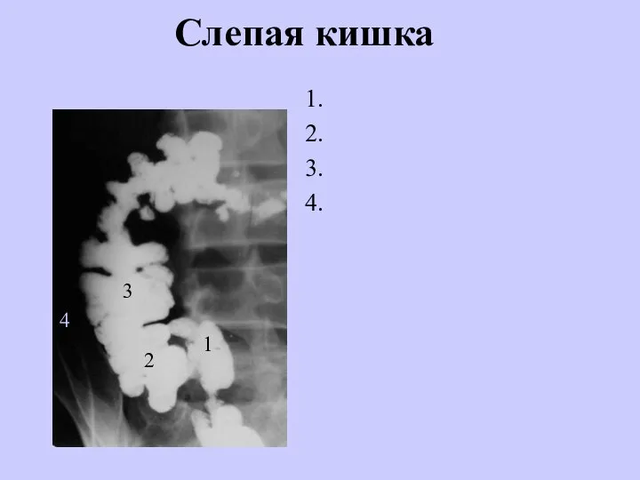 Слепая кишка 1. 2. 3. 4. 1 2 3 4