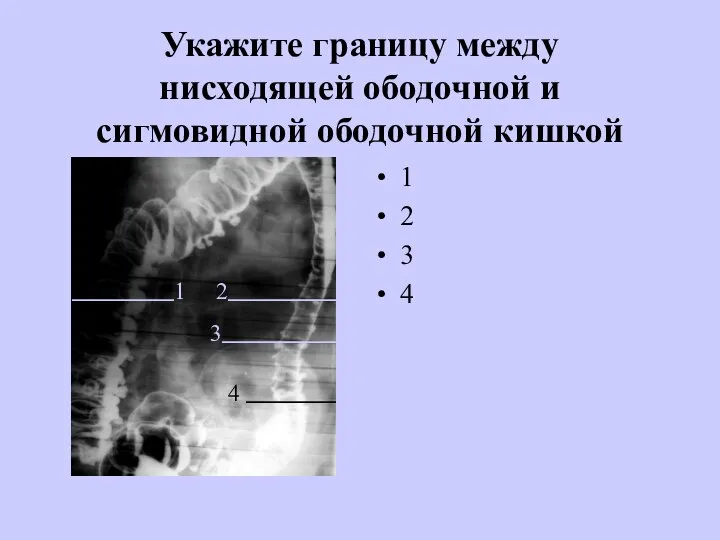 Укажите границу между нисходящей ободочной и сигмовидной ободочной кишкой 1 2 3