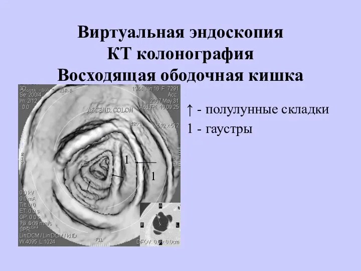 Виртуальная эндоскопия КТ колонография Восходящая ободочная кишка ↑ - полулунные складки 1 - гаустры 1 1