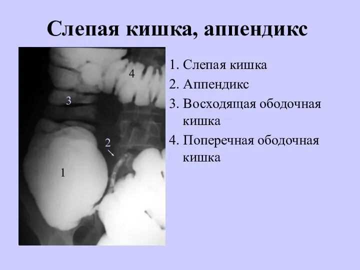 Слепая кишка, аппендикс 1. Слепая кишка 2. Аппендикс 3. Восходящая ободочная кишка