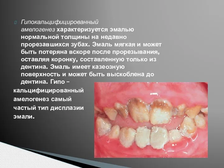 Гипокальцифицированный амелогенез характеризуется эмалью нормальной толщины на недавно прорезавшихся зубах. Эмаль мягкая
