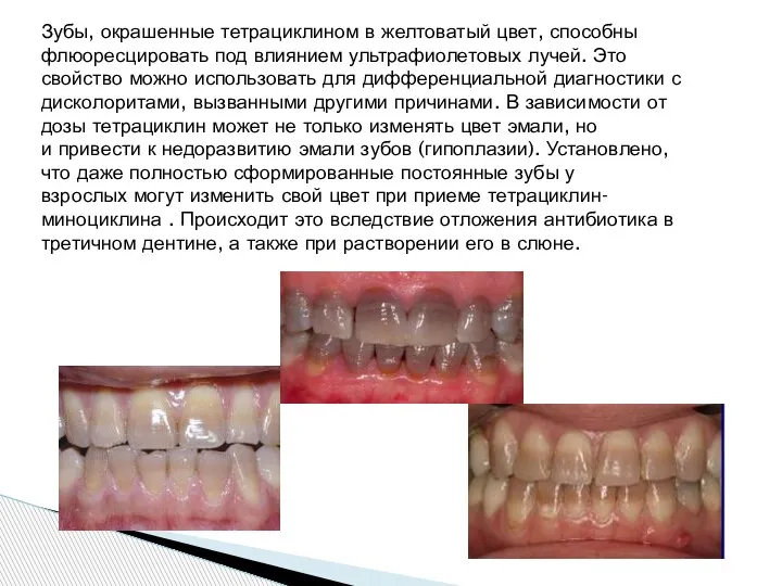 Зубы, окрашенные тетрациклином в желтоватый цвет, способны флюоресцировать под влиянием ультрафиолетовых лучей.