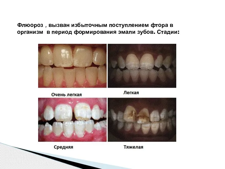 Флюороз , вызван избыточным поступлением фтора в организм в период формирования эмали зубов. Стадии: