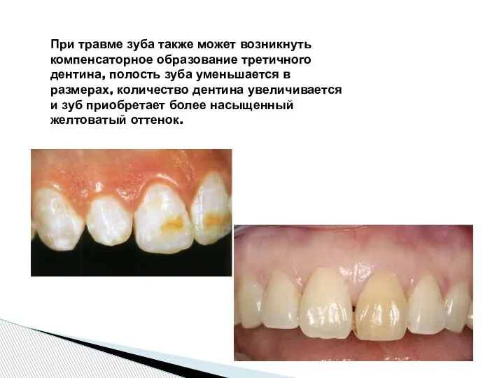 При травме зуба также может возникнуть компенсаторное образование третичного дентина, полость зуба