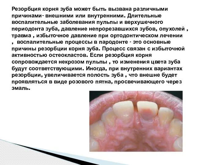 Резорбция корня зуба может быть вызвана различными причинами- внешними или внутренними. Длительные