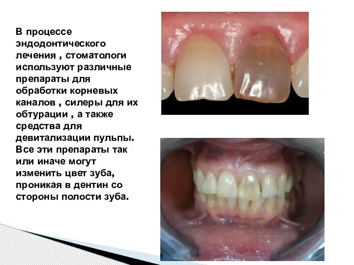 В процессе эндодонтического лечения , стоматологи используют различные препараты для обработки корневых