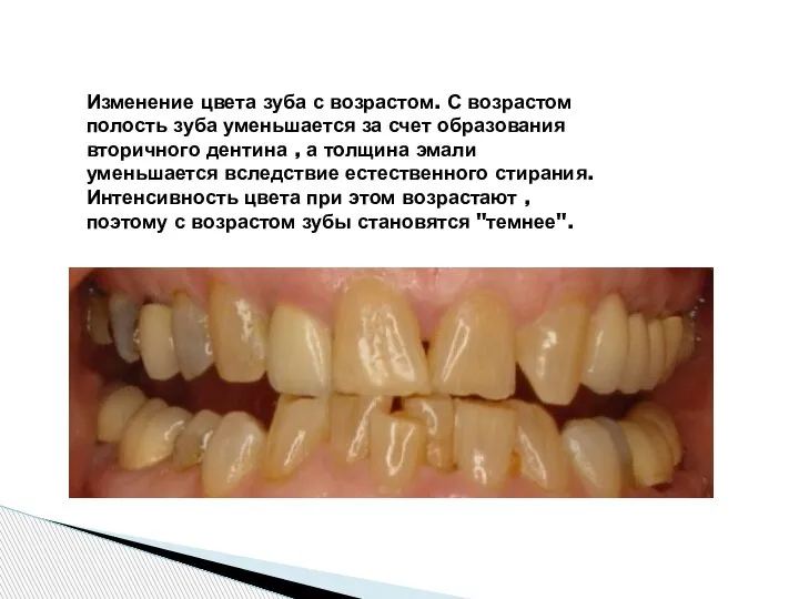 Изменение цвета зуба с возрастом. С возрастом полость зуба уменьшается за счет