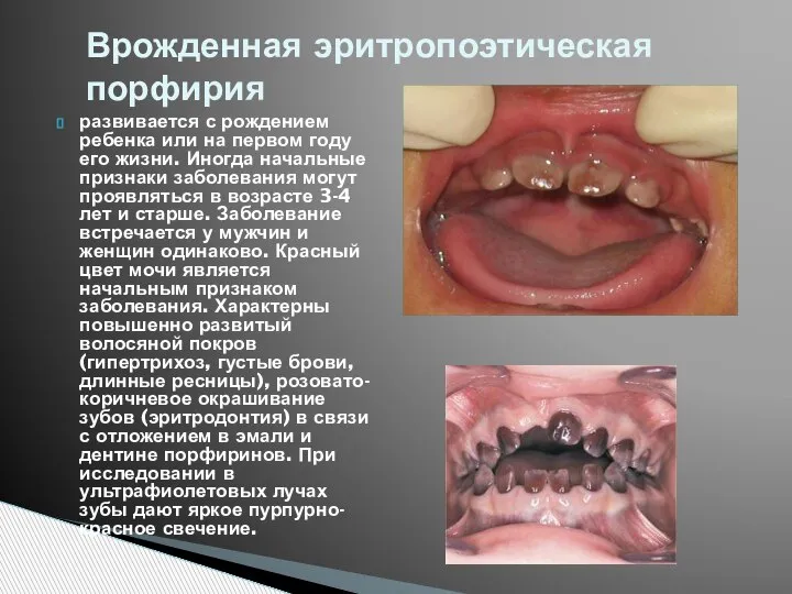 развивается с рождением ребенка или на первом году его жизни. Иногда начальные