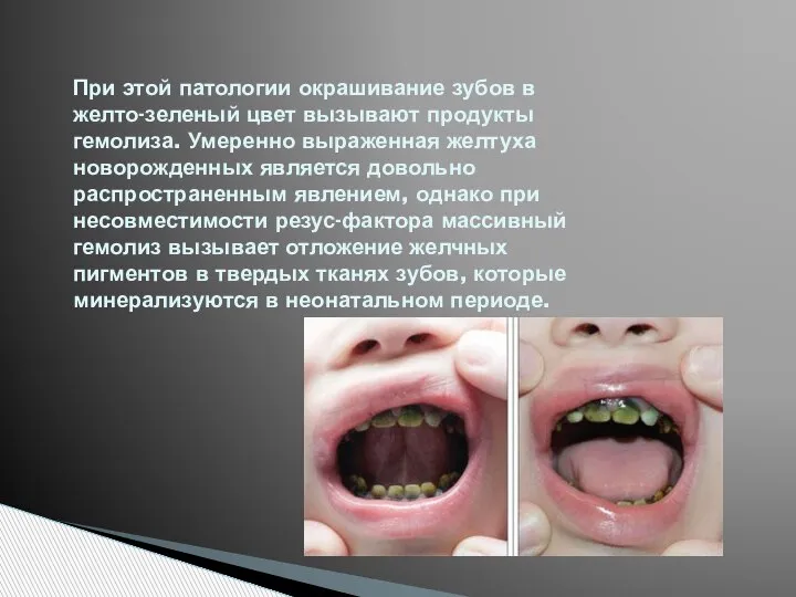 При этой патологии окрашивание зубов в желто-зеленый цвет вызывают продукты гемолиза. Умеренно