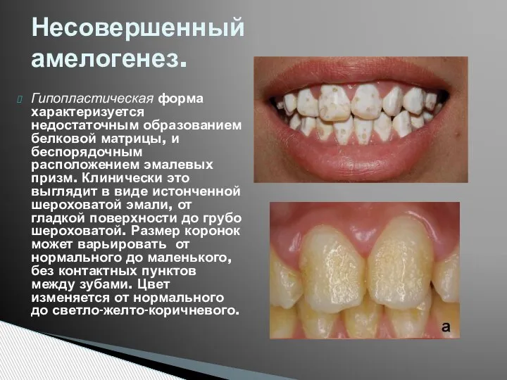 Гипопластическая форма характеризуется недостаточным образованием белковой матрицы, и беспорядочным расположением эмалевых призм.