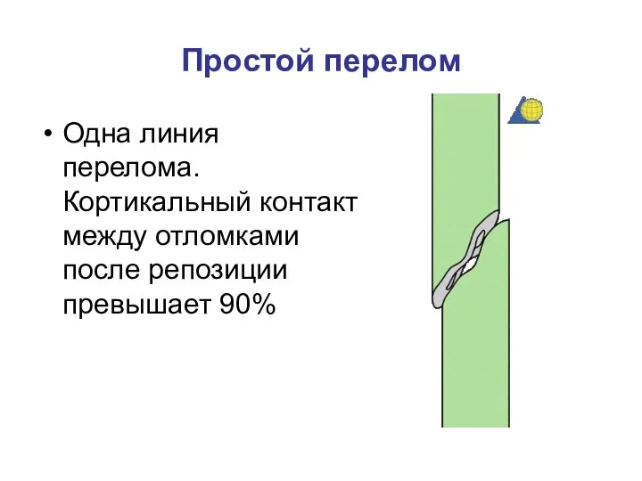 Простой перелом Одна линия перелома. Кортикальный контакт между отломками после репозиции превышает 90%