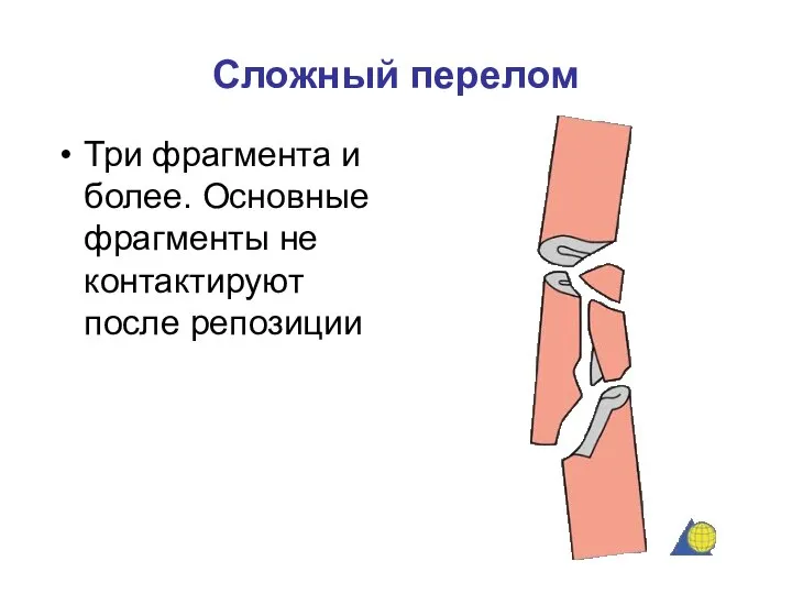 Сложный перелом Три фрагмента и более. Основные фрагменты не контактируют после репозиции