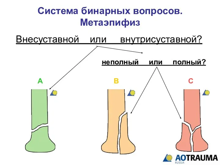 Система бинарных вопросов. Метаэпифиз Внесуставной или внутрисуставной? неполный или полный? А В С