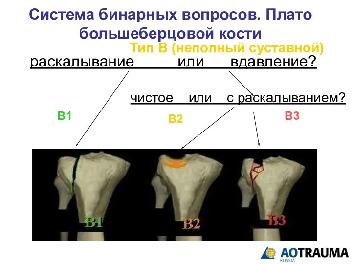 Система бинарных вопросов. Плато большеберцовой кости раскалывание или вдавление? В1 В2 В3