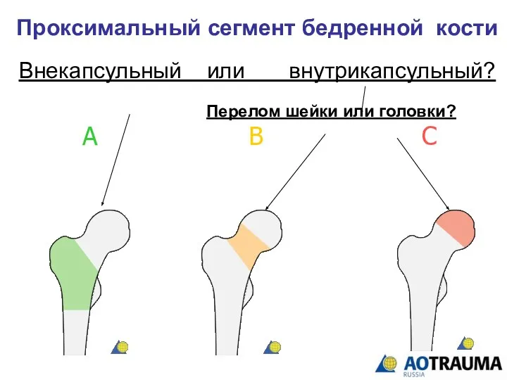 Проксимальный сегмент бедренной кости А В С Внекапсульный или внутрикапсульный? Перелом шейки или головки?