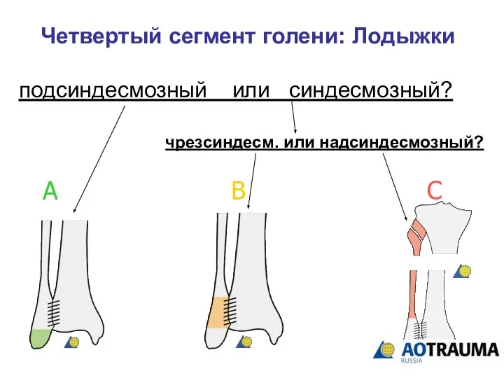 Четвертый сегмент голени: Лодыжки А В С подсиндесмозный или синдесмозный? чрезсиндесм. или надсиндесмозный?